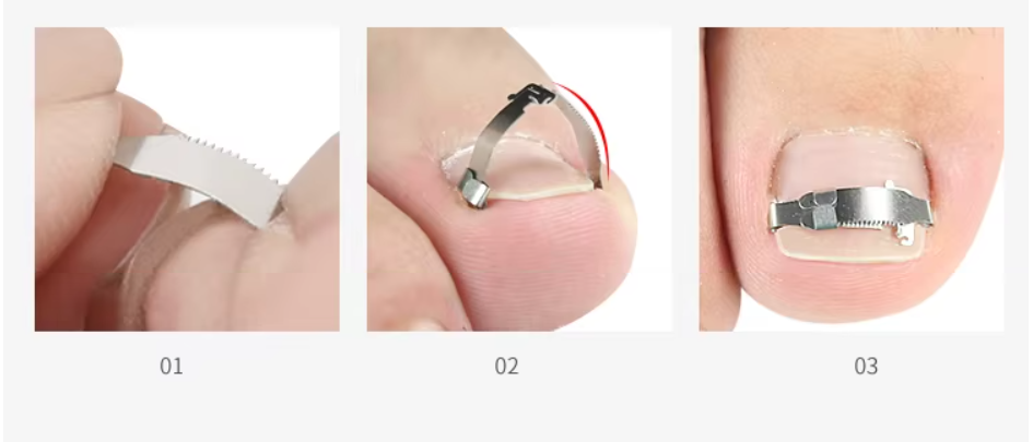 Ingrown Toenail Straightening Clip Stainless Steel Toenail Correction Clip Toenail Inset Buckle Toe Pedicure Tool (MOQ 10 Pcs)